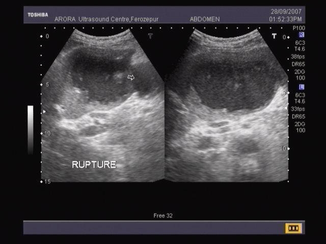 Abces hepatic